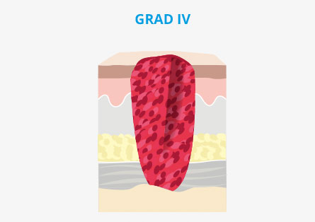 Dekubitus Grad IV