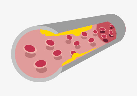 Periphere arterielle Verschlusskrankheit